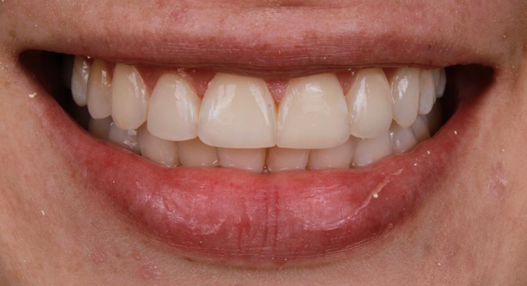 Antes diseño dental